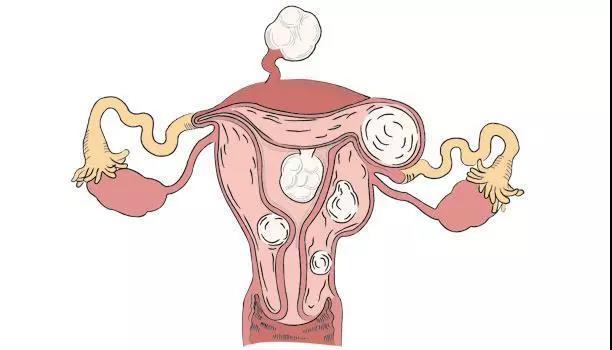 子宫肌瘤的成因有哪些会有哪些表现又该如何预防