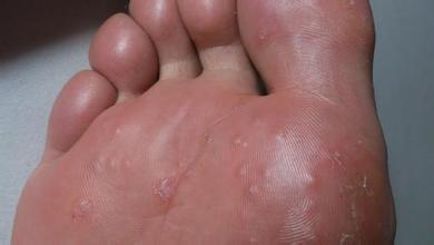 了一些小水泡挨着很多而且一茬一茬的起起完了脚上就脱皮有时候痒