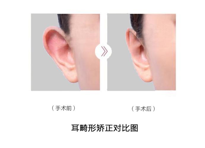 主页 爱耳科普 耳畸形治疗    招风耳双侧性较多见但两侧畸形程度有