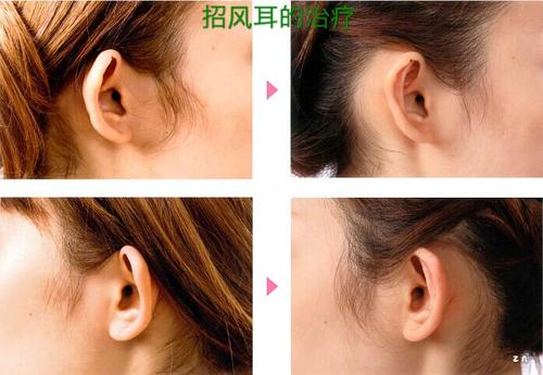 日本整形|招风耳治疗对比照