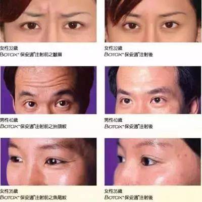 botox 保妥适