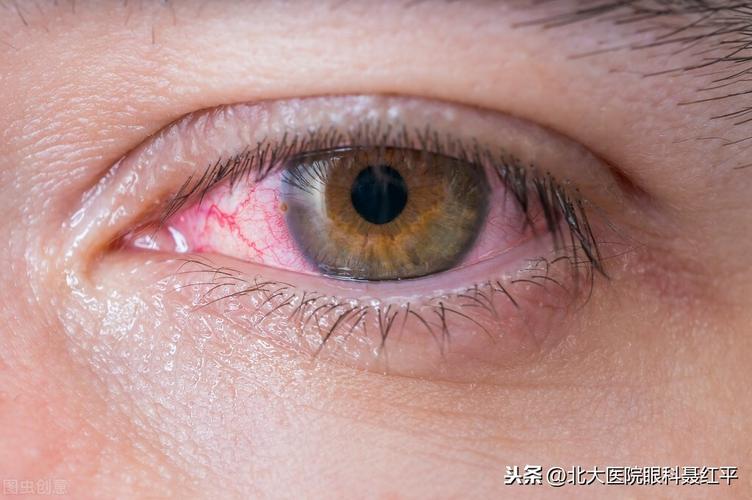 右眼眼珠红是怎么回事眼睛发红风水预兆