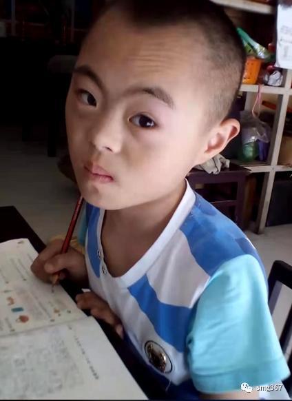 来自安徽金寨的杨杨是个唐氏综合征宝宝染色体异常导致他的智力发展