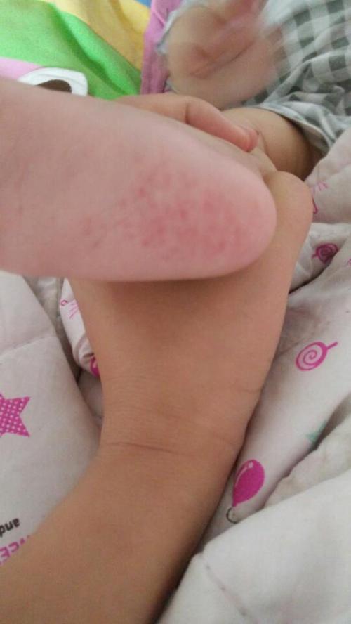 推荐回答 您好考虑是宝宝湿疹要避免让有刺激性的物质接触孩子的
