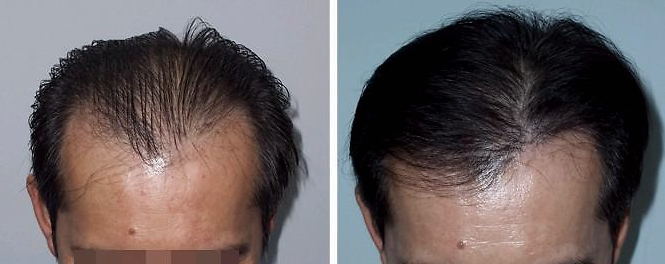 2头顶o型脱发:是指除前额发际线和两侧m型部分从其上侧至头旋部位的