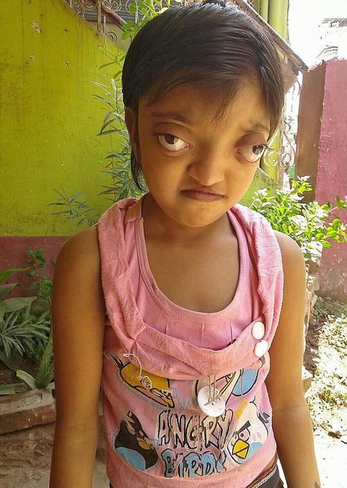 印度女孩患罕见病长