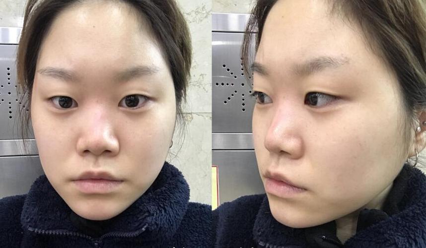 韩国高诺鼻整形外科塌鼻矫正手术照片