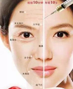 botox 用于 抬头纹川字纹口周纹笑纹鱼尾纹等因表情而引起的动态