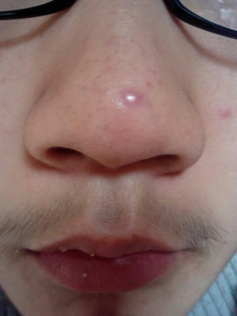 2014-03-16 李京保 医师 鼻子上的大痘长了1个多月了怎样才能快速好